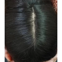 Non surgical hair replacement in Delhi